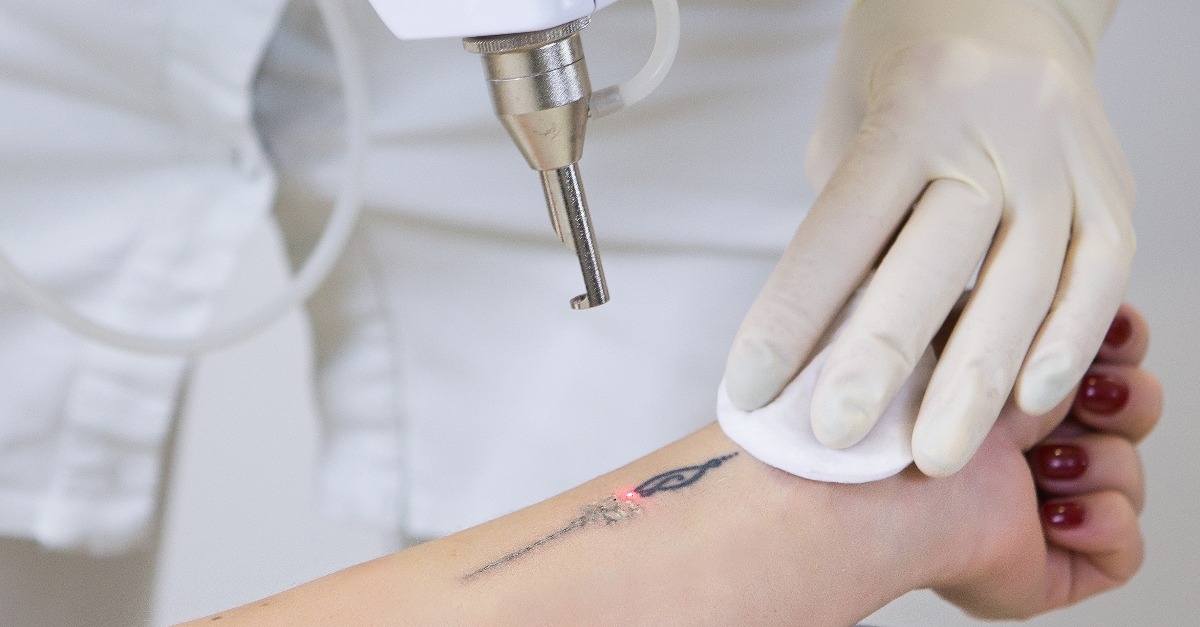 laser tattoo removal from woman's hand