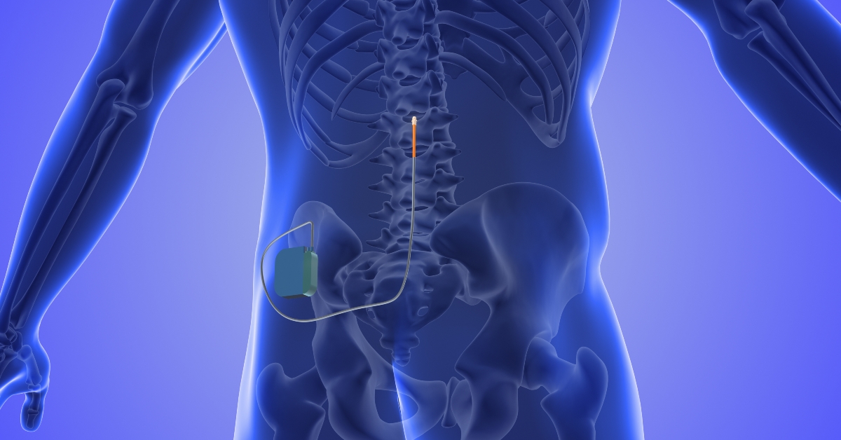 Spinal cord stimulation medical concept